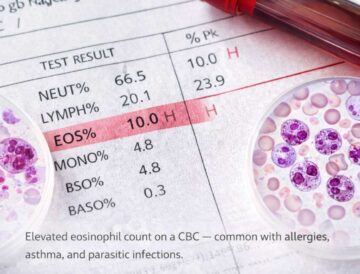 High eosinophils blood test showing elevated white blood cells