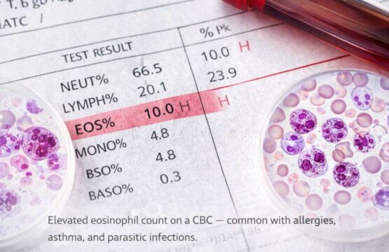 High eosinophils blood test showing elevated white blood cells