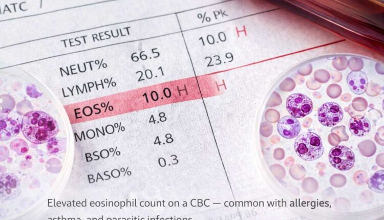 High eosinophils blood test showing elevated white blood cells