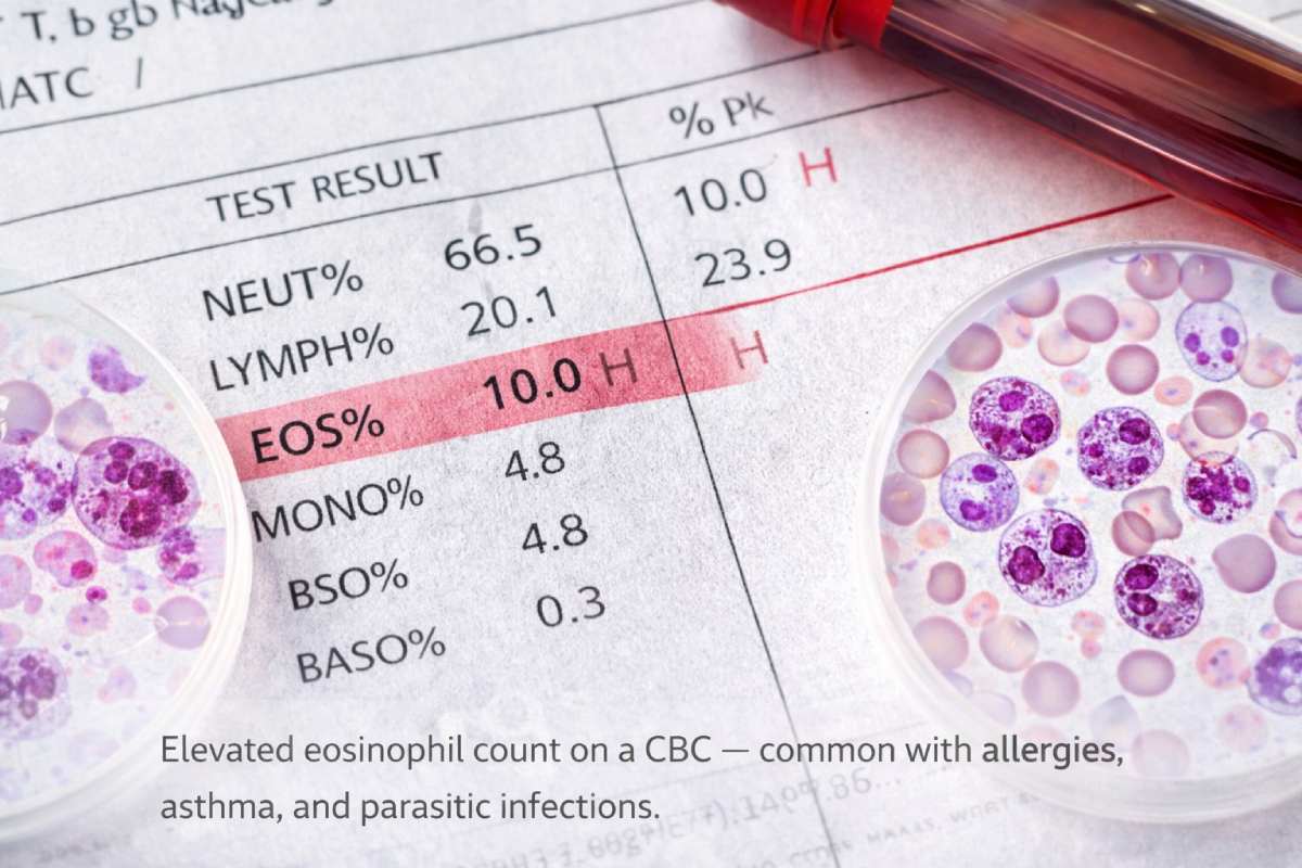 High eosinophils blood test showing elevated white blood cells