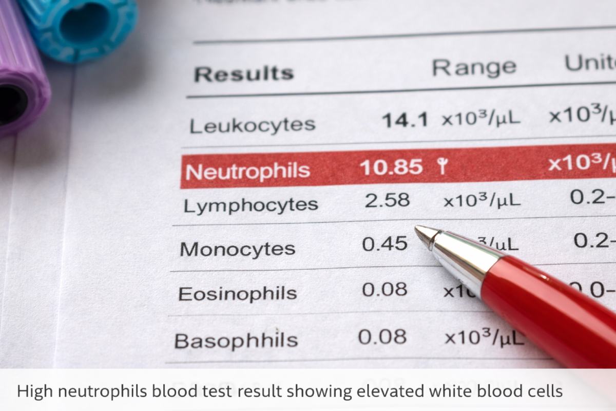 High neutrophils blood test result showing elevated white blood cells