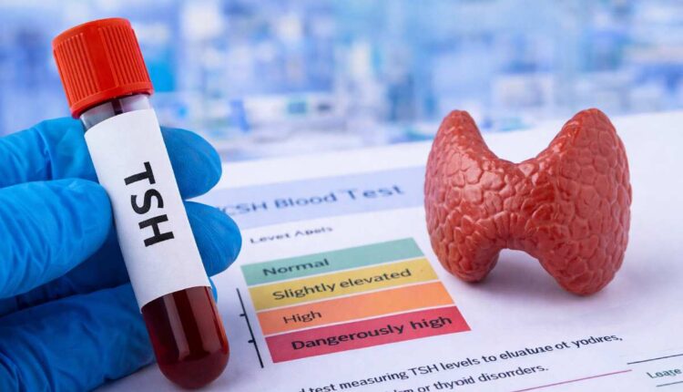 TSH levels blood test and thyroid health concept