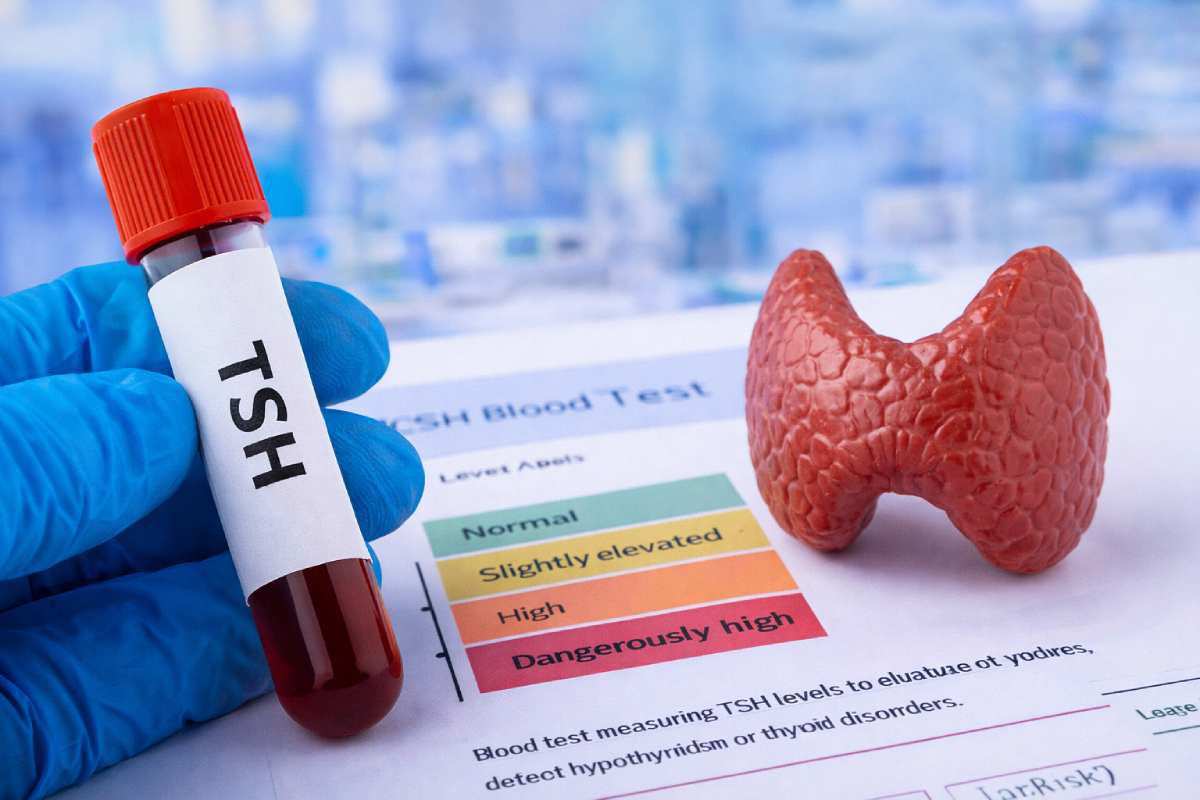 TSH levels blood test and thyroid health concept